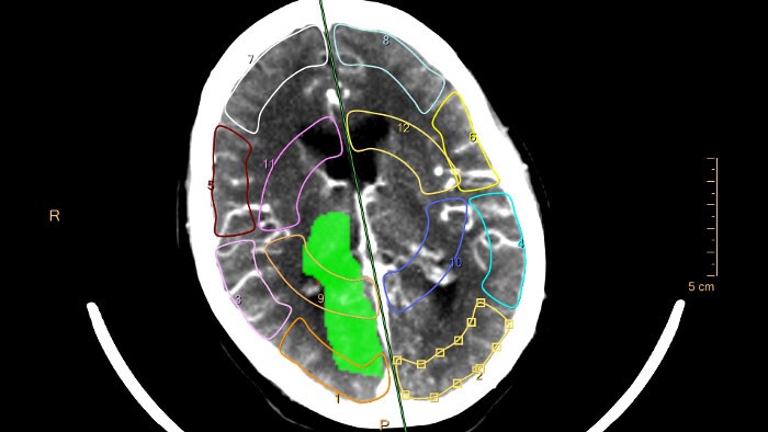 CT brain perfusion