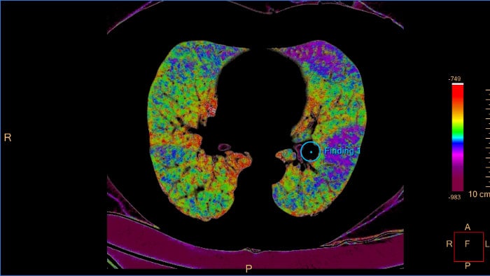 Mapa de color CT Pulmonary Artery Analysis CB