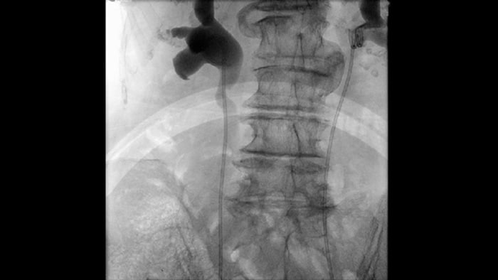 Fluoroscopia con pulso