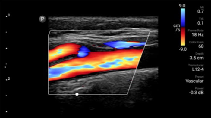 Imagen vascular en miniatura