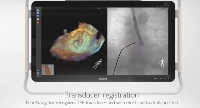 Una nueva dimensión en la imagen intervencionista combina rayos X y ultrasonido 3D en directo