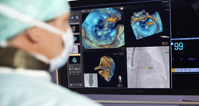 Tratamiento de la cardiopat&iacute;a estructural con intervenci&oacute;n guiada por imagen